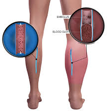 liposuction treatment doctor in Kompally
